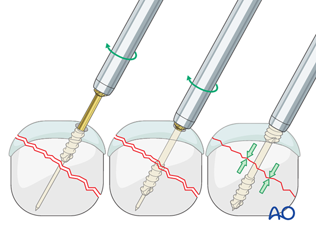 Headless compression screw insertion