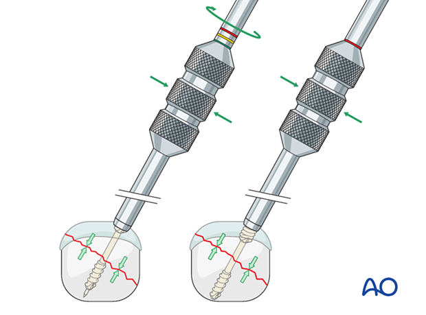 Compression of an articular fracture with a headless compression screw – Advancing the screw until the head is flush with the bone