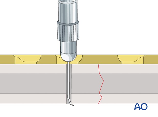 Determination of screw length