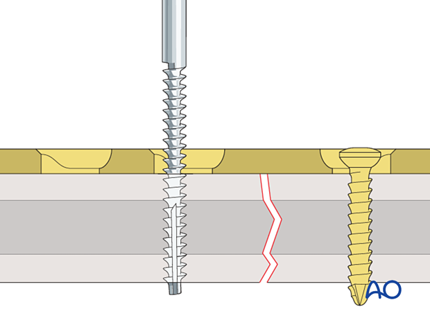 Tapping of screw holes
