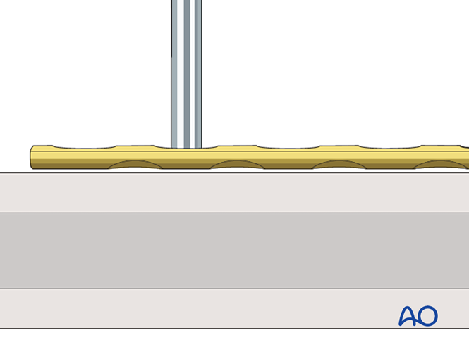 Locking head screw insertion