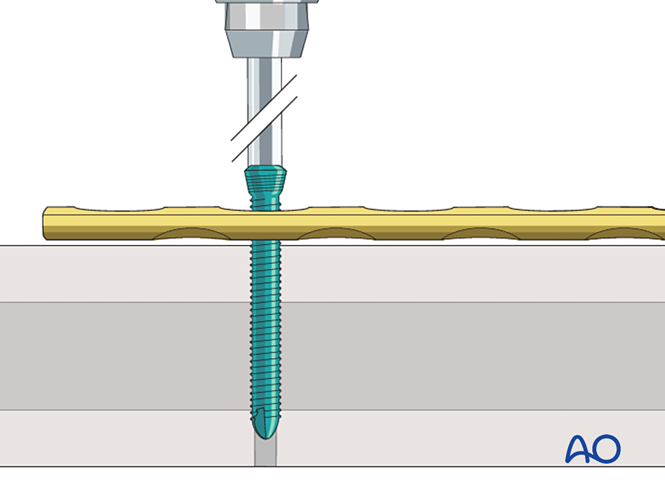 Locking head screw insertion