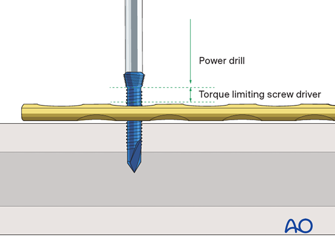 Locking head screw insertion