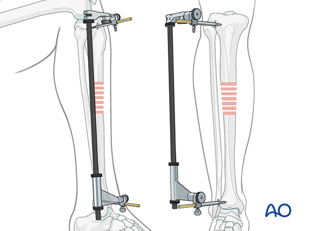 Intramedullary nailing - a large distractor is usually placed in the proximal and distal segments.