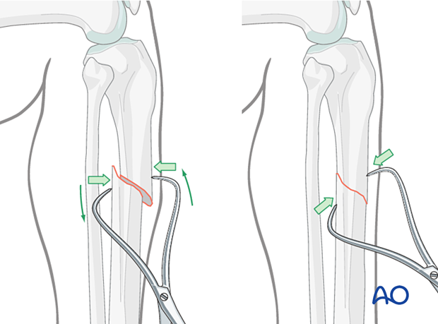 Oblique or spiral fractures can often be reduced with pointed reduction forceps applied percutaneously.