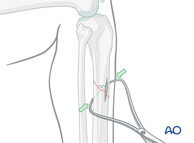 If the fracture is oblique, a bone clamp, placed percutaneously, with its tips perpendicular to the fracture plane, can be used to compress the fracture surfaces.