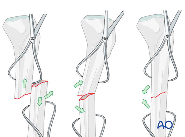 If the fracture is transverse, it may be reduced with manipulation using clamps on the bone ends.