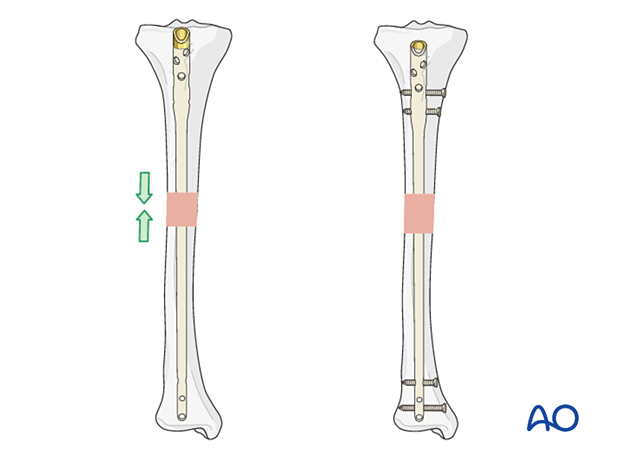 Intramedullary nailing - Multifragmentary fractures are not length stable. Therefore, proximal and distal locking screws must be used.