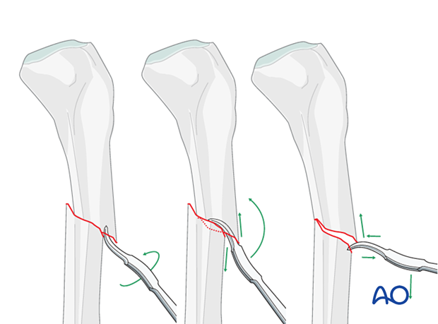 If the fracture is transverse a Hohmann retractor can be used for reduction