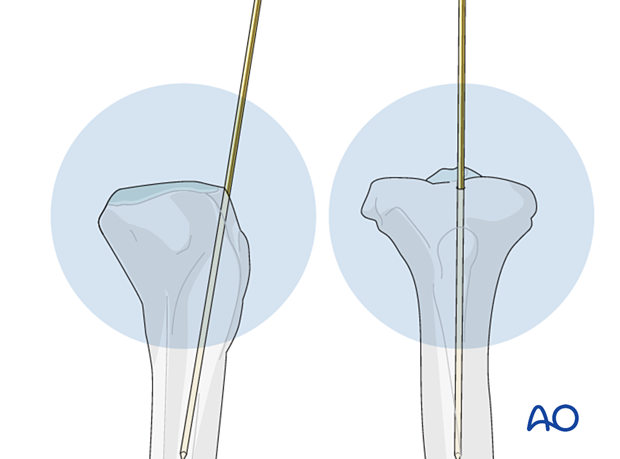 Insertion of guide wires