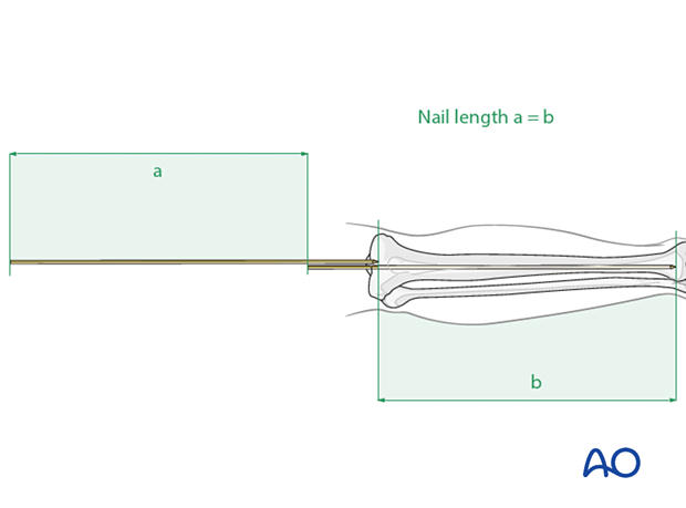 Determination of length using second guide wire