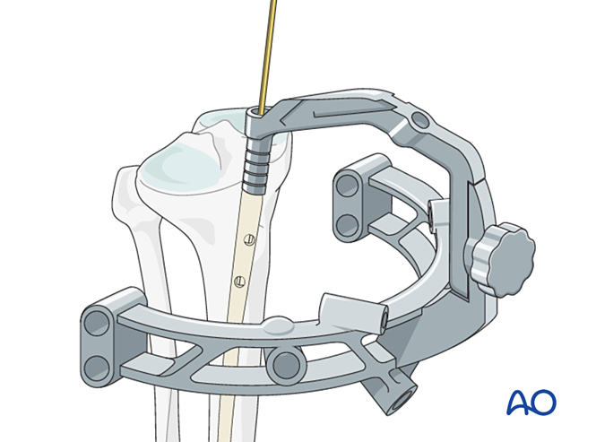 basic principles of im nailing new