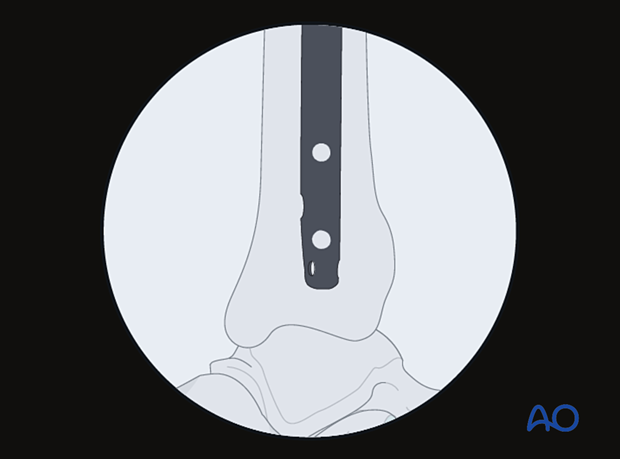 The central ray of the fluoroscope must pass through the locking hole during distal locking