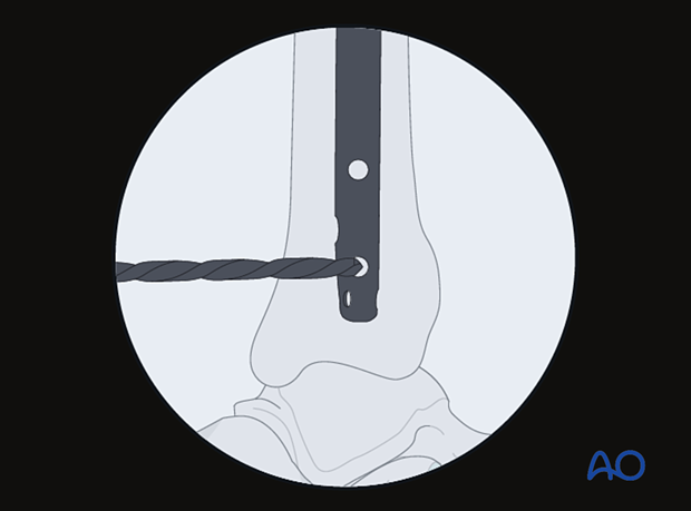 The drill tip is positioned over the center of the locking hole during distal locking