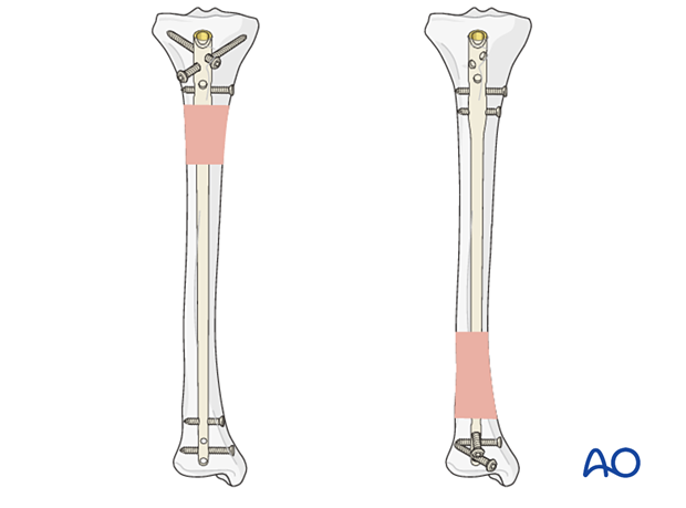 Intramedullary nailing of a tibial shaft fracture