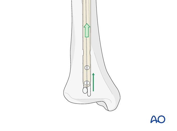 Insertion of additional straight guide wires that are passed out through the tip of the nail