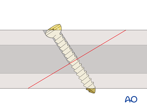 Compression of oblique fracture