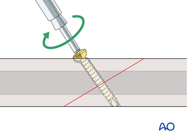 Insertion of self-tapping screw