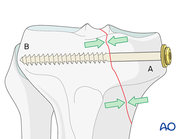 Headless compression screw insertion