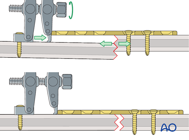 Distraction using articulated tension device