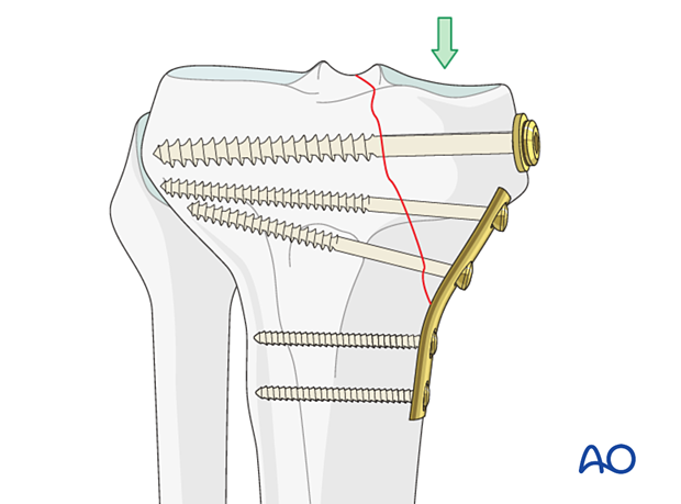 Buttress plate applied to proximal tibia fracture