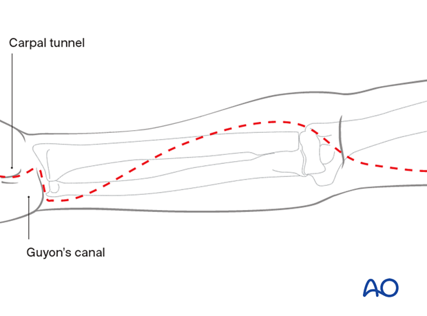 Compartment syndrome of the arm – anterior fasciotomy approach