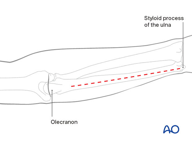 Compartment syndrome of the arm – posterior fasciotomy approach