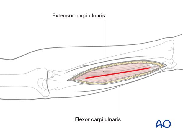 Compartment syndrome of the arm – posterior fasciotomy approach – deep dissection