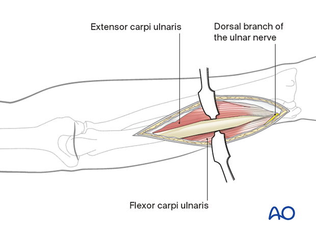 Compartment syndrome of the arm – posterior fasciotomy approach – position of the dorsal branch of the ulnar nerve