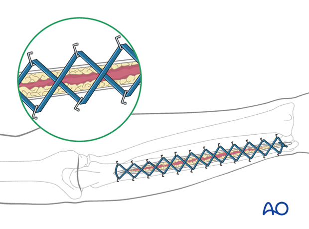 Using elastic retention sutures for temporary soft-tissue management of the arm