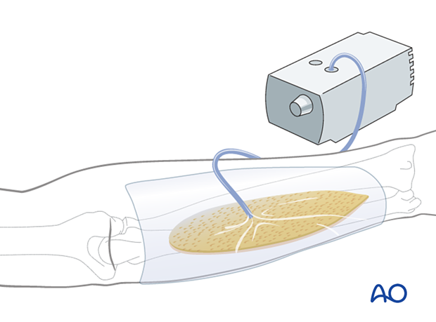 Using a CA to enhance wound healing of the arm