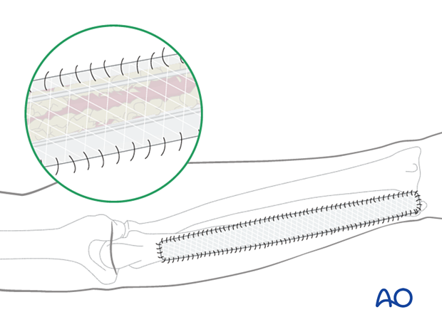 Secondary wound coverage of the arm