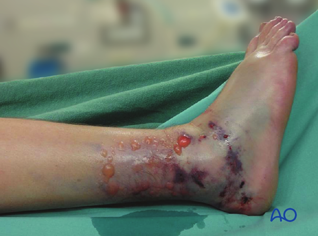 Compartment syndrome in the foot - a distal tibial plafond fracture with swelling and bruising, resulting in fracture blisters. Compartment syndrome should be ruled out.
