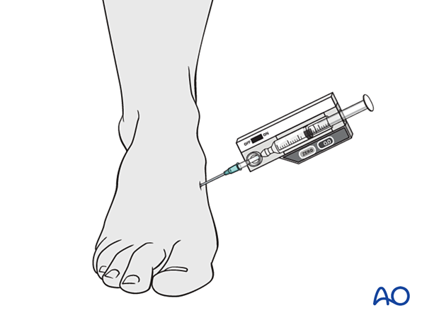Compartment syndrome in the foot - intracompartmental pressure measurement