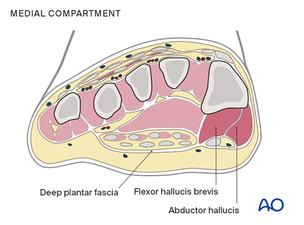 Compartment syndrome in the foot – medial compartment