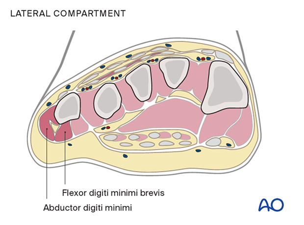 Compartment syndrome in the foot - lateral compartment