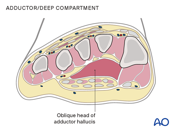Compartment syndrome in the foot – adductor/deep compartment