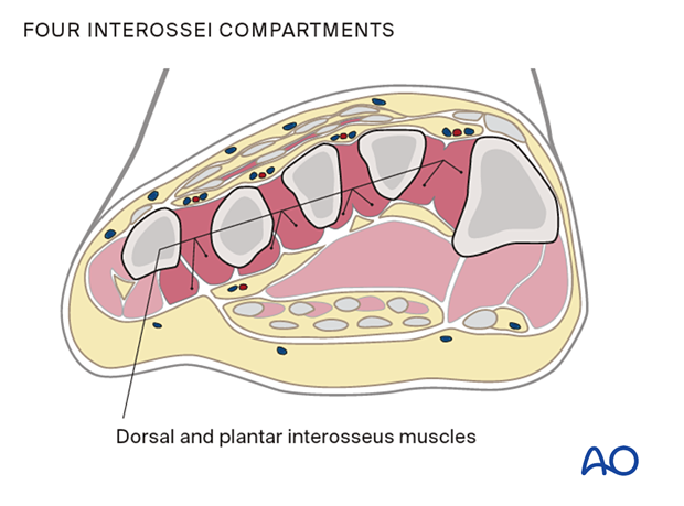 Compartment syndrome in the foot – the four interossei compartments