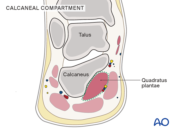 Compartment syndrome in the foot - calcaneal compartment
