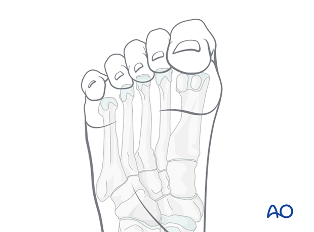 Compartment syndrome in the foot – this may lead to intrinsic toe contractures, and claw toe or hammer toe