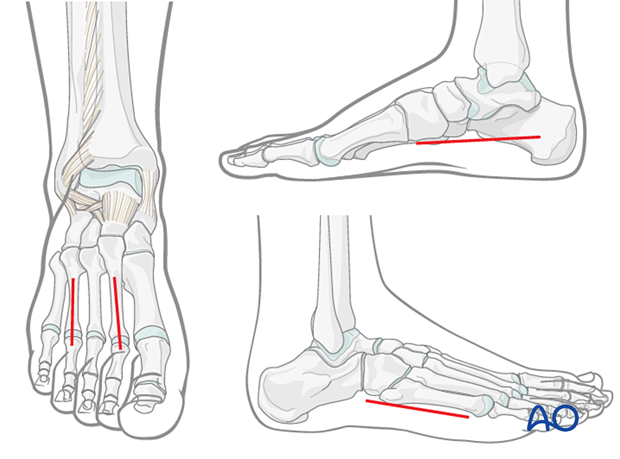 Compartment syndrome in the foot – fasciotomies