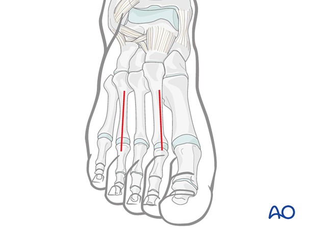 Compartment syndrome in the foot – the two dorsal incisions