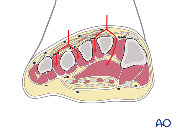 Compartment syndrome in the foot – the fasciae of the interosseous muscles are opened dorsally