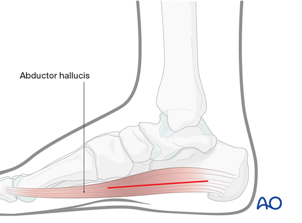 Compartment syndrome in the foot – the medial incision