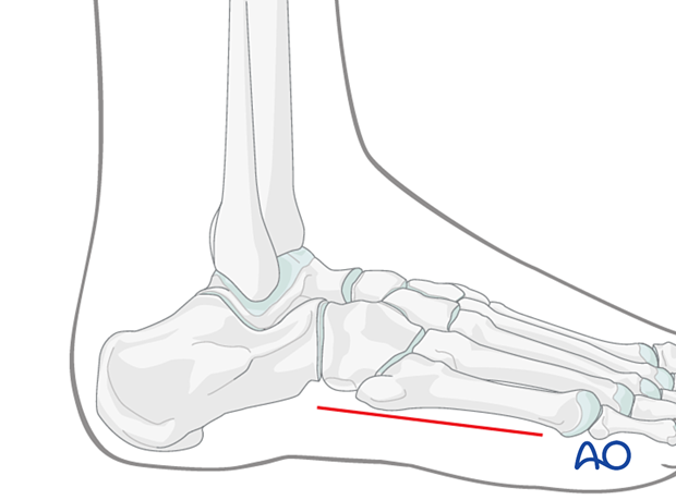 Compartment syndrome in the foot – lateral incision