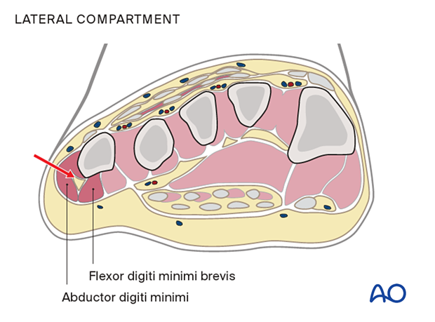 80 X010 Compartment syndrome foot