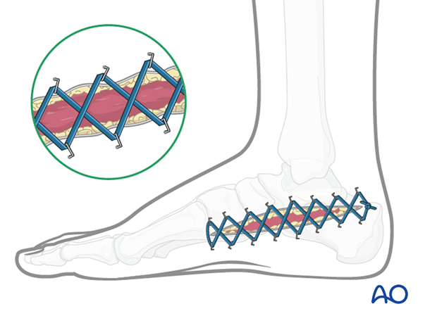 Compartment syndrome in the foot – use of elastic retention sutures