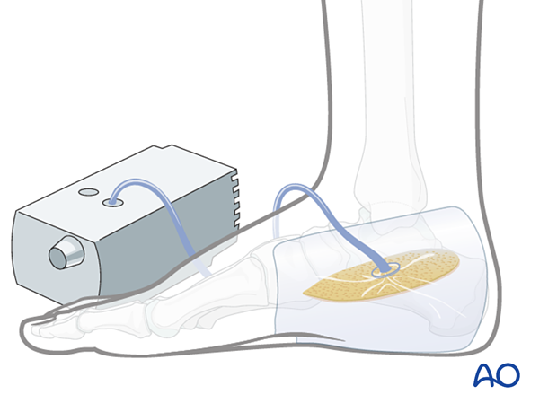 Compartment syndrome in the foot – use of a wound vacuum-assisted closure (VAC) device