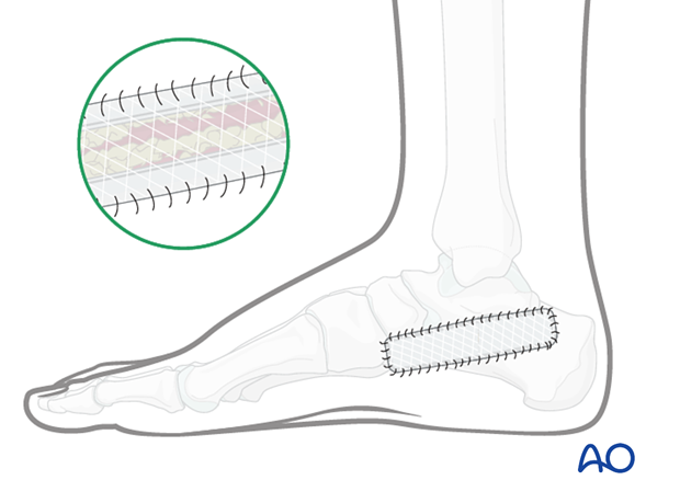 Compartment syndrome in the foot – delayed soft-tissue management: secondary coverage