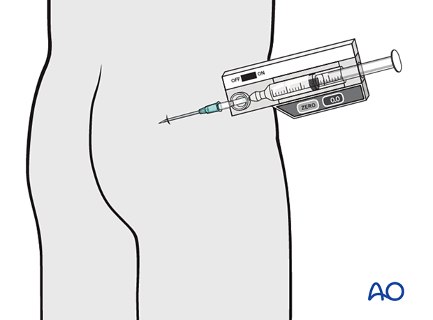Compartment syndrome in the gluteal region - intracompartmental pressure measurement
